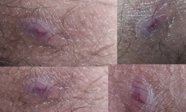 Zmiany skórne w pachwinach, zaczerwienienie i podrażnienie. Zastanawiasz się, czym smarować odparzenia w pachwinach u dorosłych?