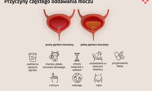 Ilustracja pokazuje przyczyny częstego oddawania moczu, w tym problemy z kręgosłupem lędźwiowym, które mogą wpływać na pęcherz.