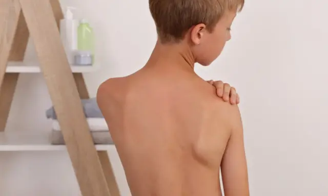 Chłopiec z nierównymi łopatkami, jedna z nich jest wyraźnie wyżej.