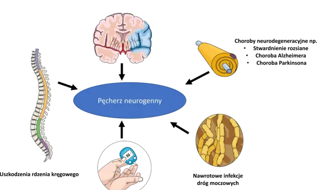 Ilustracja przedstawia mózg, rdzeń kręgowy, neuron i glukometr, sugerując, czy pęcherz neurogenny da się wyleczyć.