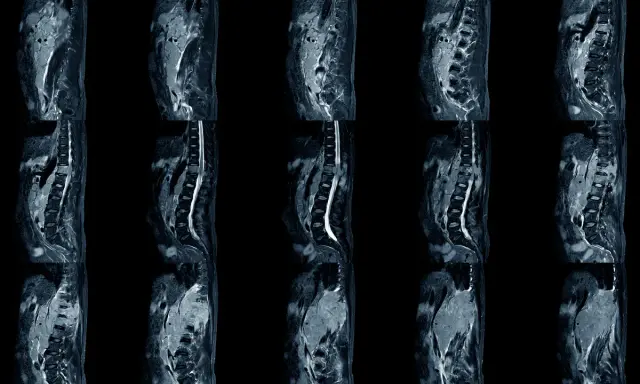 Sześć przekrojów rezonansu magnetycznego kręgosłupa lędźwiowego, ukazujących zmiany typowe dla spondyloartrozy, kluczowe dla planowania leczenia.
