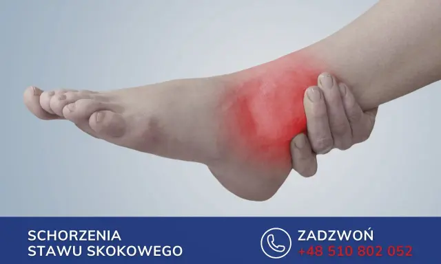Obrzęk po złamaniu kostki może utrzymywać się długo. Zobacz, jak długo puchnie noga po złamaniu kostki i jak uzyskać pomoc.