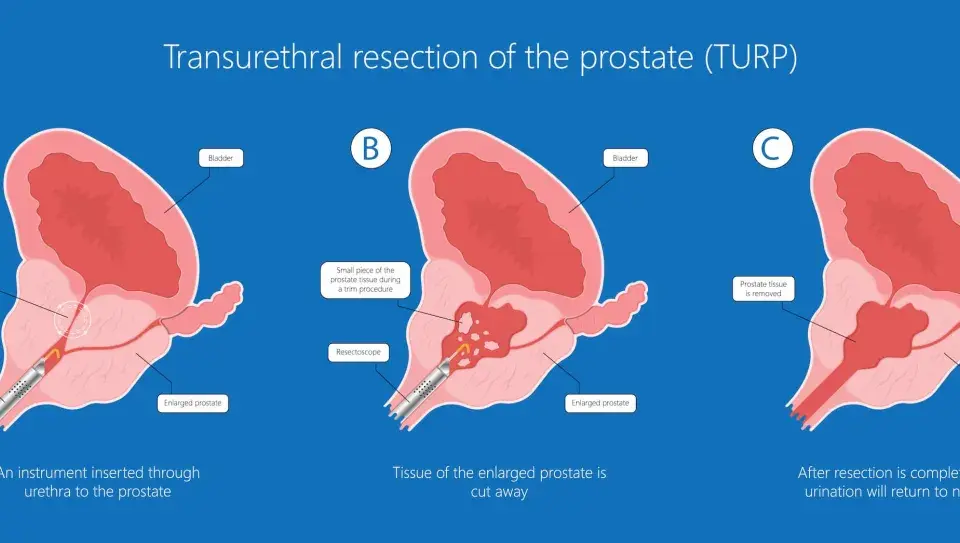 Ilustracja pokazuje przebieg resekcji przezcewkowej prostaty (TURP). Po zabiegu rekonwalescencja po operacji prostaty TURP pozwala na powrót do normalnego oddawania moczu.