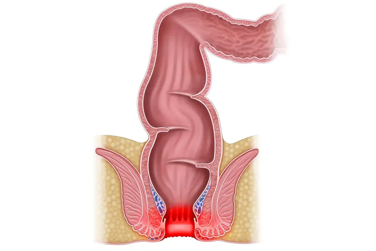 Ilustracja anatomiczna przedstawiająca odparzenia odbytu, z zaczerwienieniem i stanem zapalnym w okolicy odbytu.