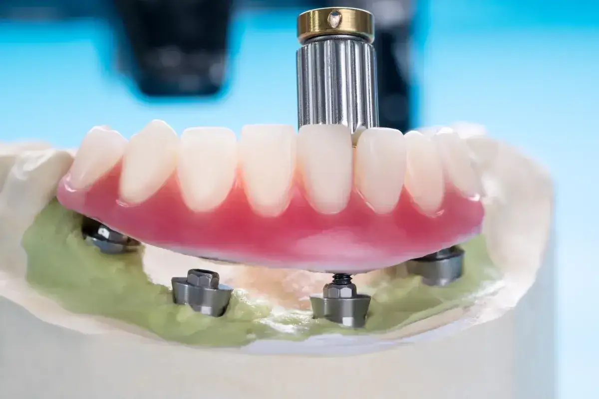 Model szczęki z implantami, gotowy do montażu. Taka proteza na NFZ to szansa na nowy uśmiech.
