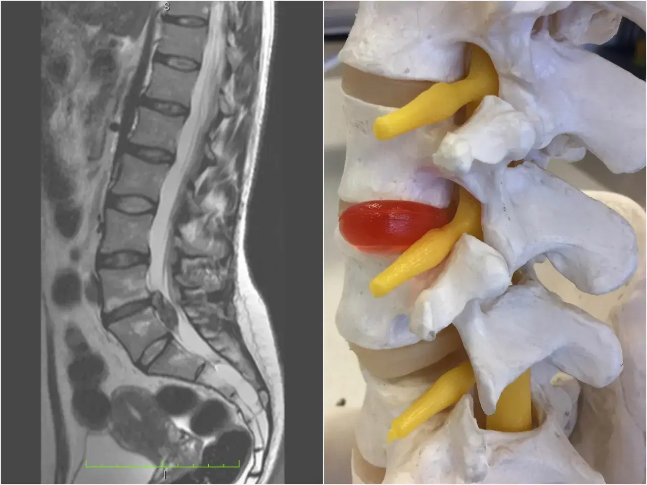 MRI kręgosłupa lędźwiowego obok modelu anatomicznego, gdzie widoczne jest czerwone jądro miażdżyste w kręgosłupie uciskające nerw.