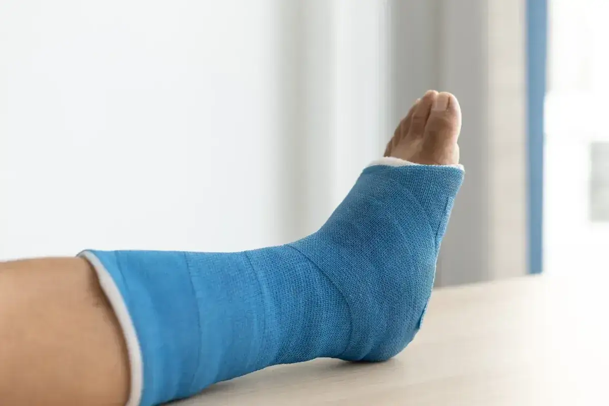 Niebieski gips na nodze po złamaniu trójkostkowym. Kiedy można chodzić po takim urazie?