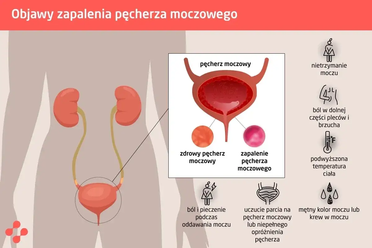 Objawy zapalenia pęcherza: nietrzymanie moczu, ból, pieczenie, uczucie parcia na pęcherz moczowy, mętny mocz.
