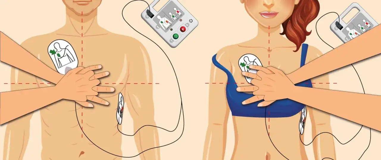 Ilustracja pokazuje, jak działa defibrylator: elektrody przyklejane są do klatki piersiowej, a urządzenie analizuje rytm serca.