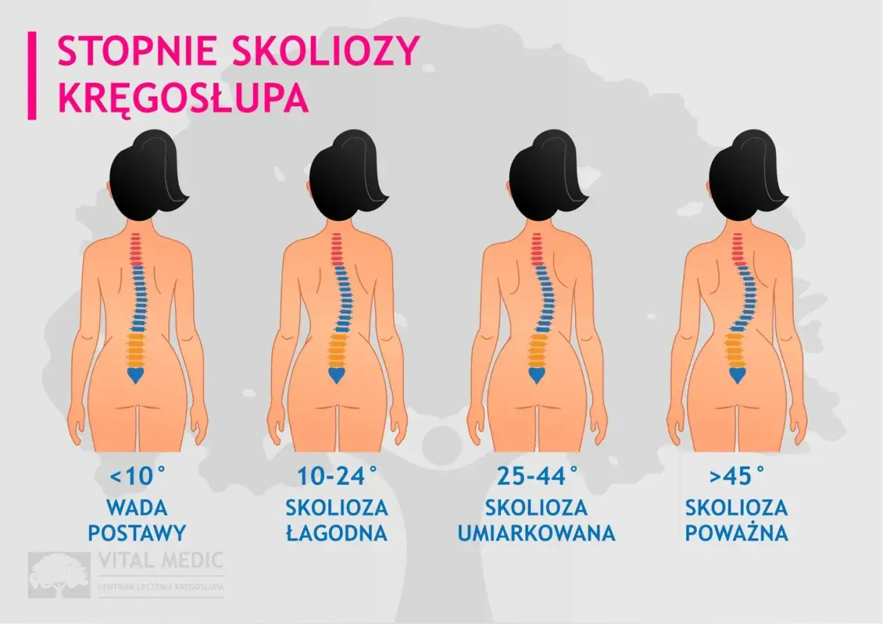 Ilustracja pokazuje stopnie skoliozy kręgosłupa: od wady postawy (<10°) do skoliozy łagodnej (10-24°), umiarkowanej (25-44°) i poważnej (>45°).